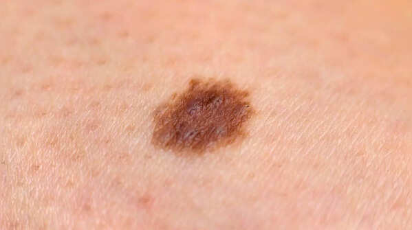 Recognizing pigment changes around a mole as a warning sign
