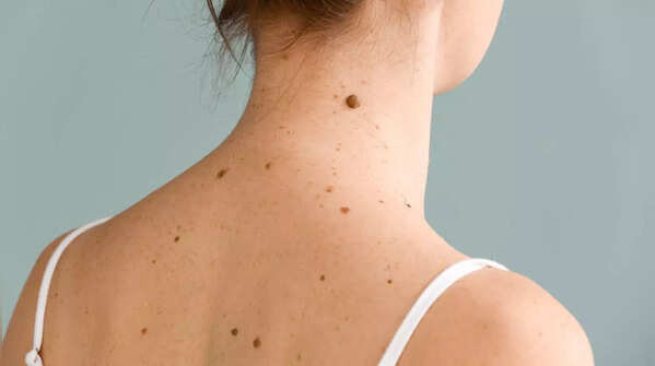 Detecting new skin growths and their potential link to cancer