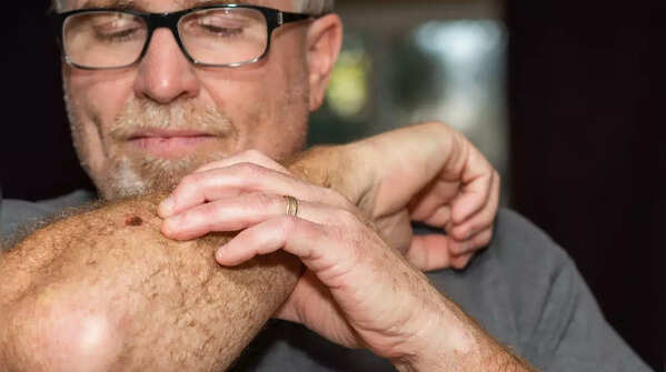 Understanding the ABCDE rule for melanoma detection