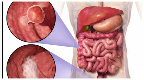 Early detection of blood in stool is crucial