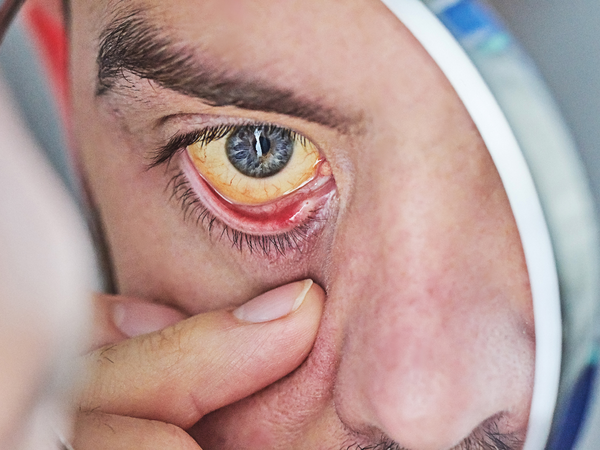 Yellowing of eyes and skin as a sign of jaundice