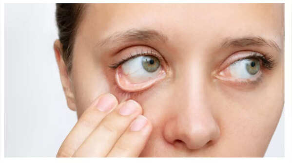 Image showing pale conjunctiva in the eye, a sign of anemia.