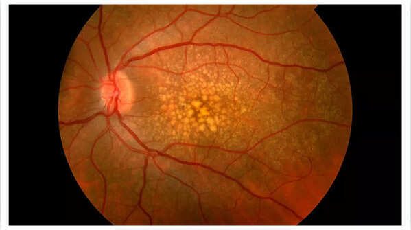 Diagram illustrating the effect of macular degeneration on vision.