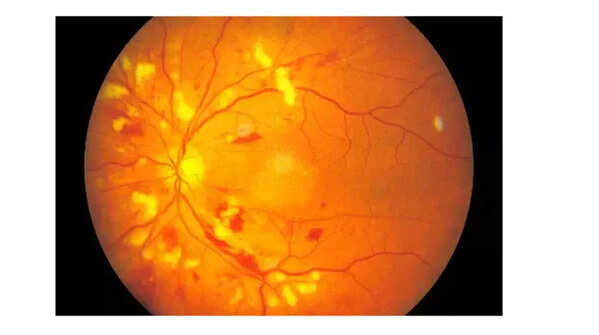 Image depicting blood vessels in the eye affected by high blood pressure.