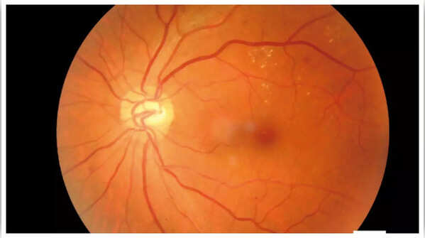 Illustration of diabetic retinopathy affecting the retina.